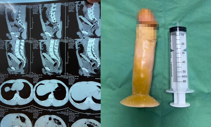 Chàng trai mắc kẹt dương vật giả trong trực tràng khi thủ dâm - Ảnh 2. Chàng trai mắc kẹt dương vật giả trong trực tràng khi thủ dâm - Ảnh 2.