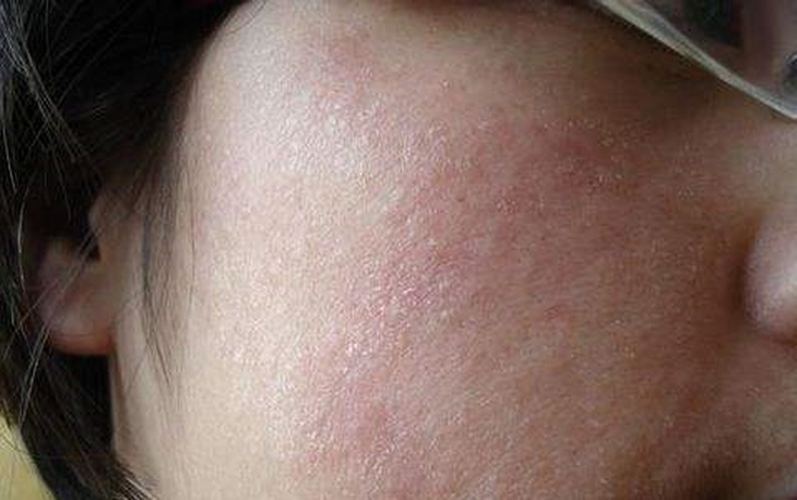 Bí quyết chăm sóc da khô khi thời tiết lạnh - Ảnh 1.