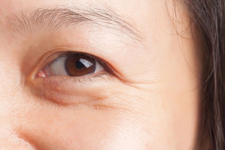Da dưới mắt chảy xệ khắc phục thế nào? - Ảnh 1.