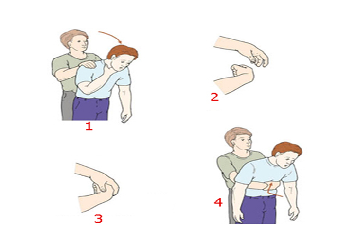 Nghiệm pháp Heimlich cần được sử dụng khi tắc nghẽn đường thở nặng và đe dọa tính mạng khi người cao tuổi hay người đang ốm, mệt mỏi Nghiệm pháp Heimlich cần được sử dụng khi tắc nghẽn đường thở nặng và đe dọa tính mạng khi người cao tuổi hay người đang ốm, mệt mỏi