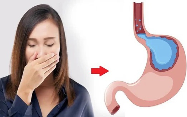 5 biến chứng nguy hiểm của trào ngược dạ dày thực quản