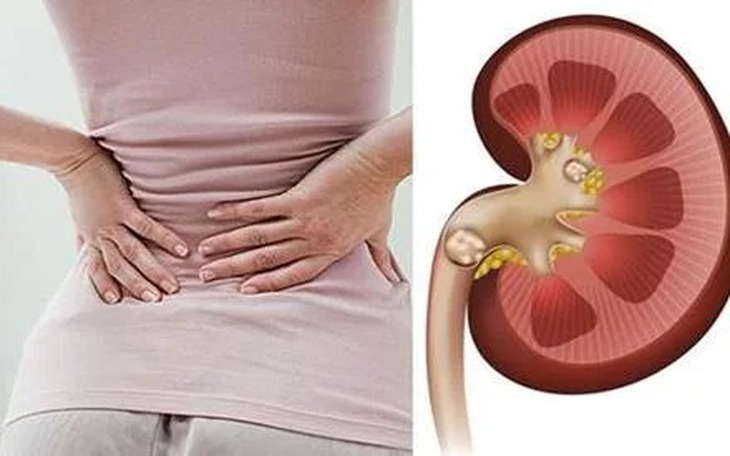 Suýt mất mạng vì bị sỏi thận sau 1 năm tự uống thuốc nam tại nhà