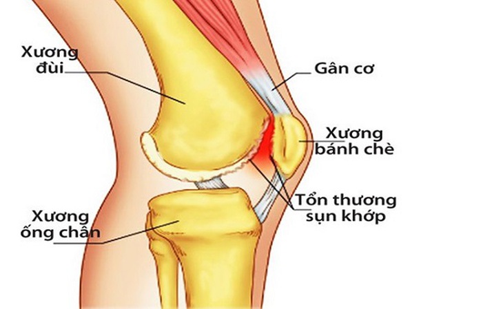 Viêm khớp gối là tình trạng xảy ra khi các thành phần tronng khớp gối bị tổn thương do nhiều nguyên nhân gây bệnh, tình trạng kéo dài có thể dẫn tới bào mòn sụn khớp khiến khớp chà xát và khó khăn khi vận động.
