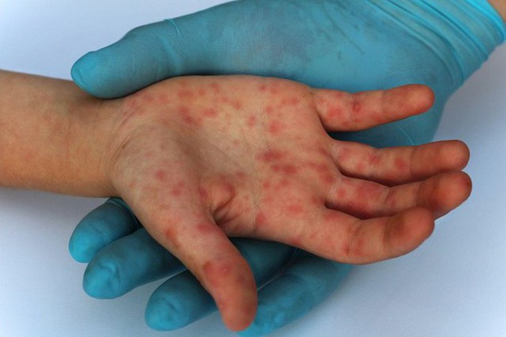 18/20 ca mắc đậu mùa khỉ ở TPHCM nhiễm HIV, 2 ca diễn tiến nặng  - Ảnh 1.