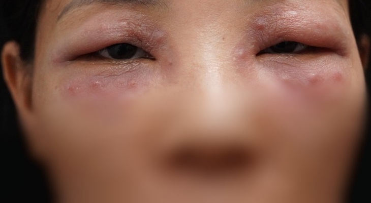 Nhiều ‘quý bà’ loét da, phù mặt do muốn làm đẹp nhanh - Ảnh 2. Nhiều ‘quý bà’ loét da, phù mặt do muốn làm đẹp nhanh - Ảnh 2.
