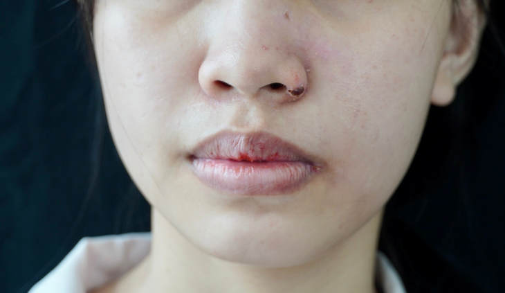 Nhiều ‘quý bà’ loét da, phù mặt do muốn làm đẹp nhanh - Ảnh 4. Nhiều ‘quý bà’ loét da, phù mặt do muốn làm đẹp nhanh - Ảnh 4.