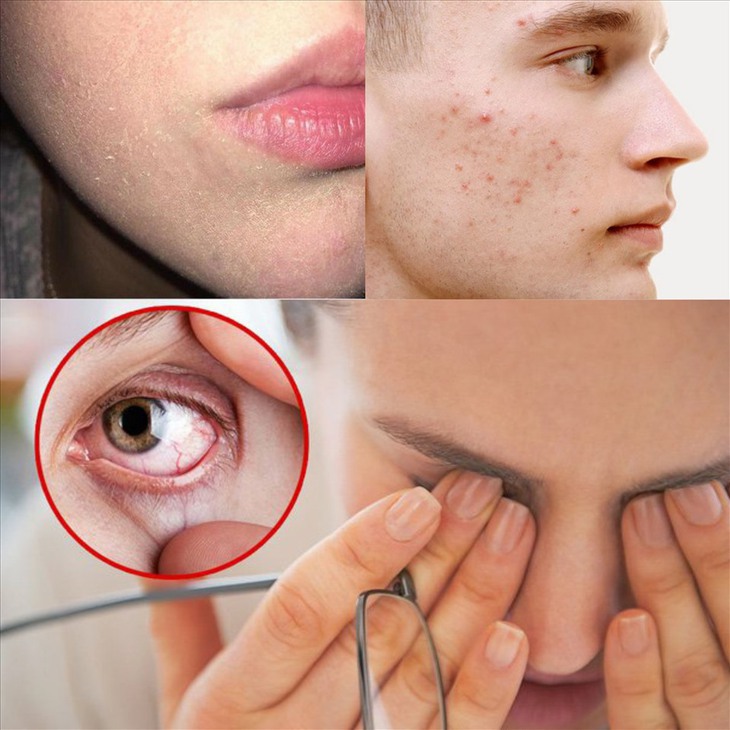 Dấu hiệu làn da thiếu vitamin và cách xử trí - Ảnh 1.