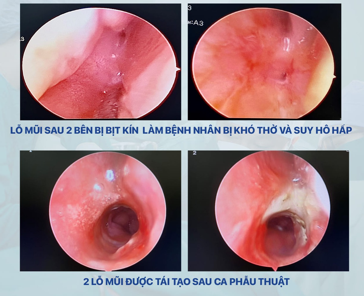 Cứu sống trẻ sơ sinh bị dị tật tịt lỗ mũi sau hai bên hiếm gặp - Ảnh 2.