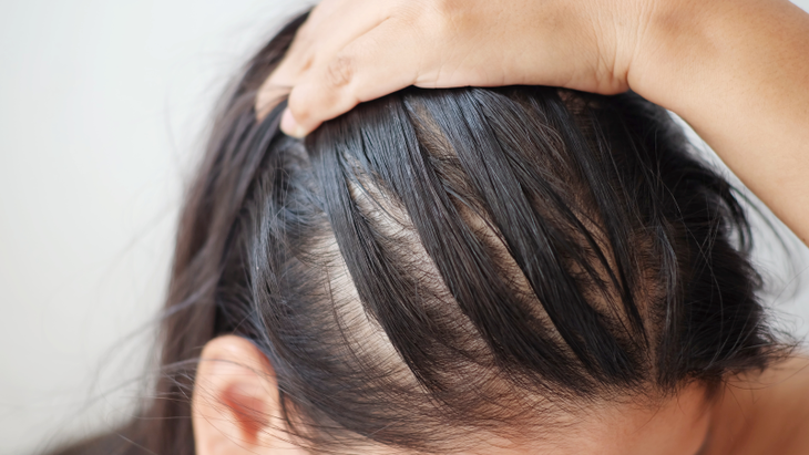 Vì sao bị rụng tóc nhiều? - Ảnh 1.