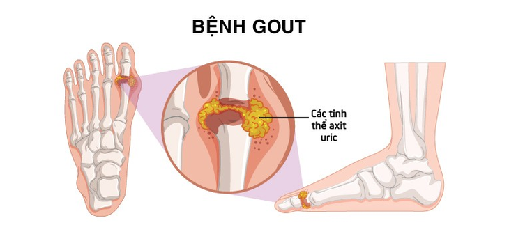 Từ bỏ những thói quen ăn uống dưới đây để hạn chế acid uric tăng - Ảnh 4.