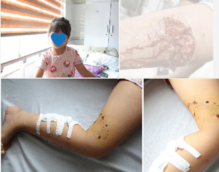 2 trẻ em bị nhiễm trùng do tụ cầu vàng sau khi bị chó cắn - Ảnh 2.