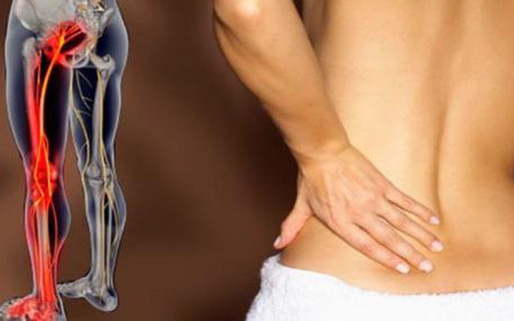 Đau thần kinh tọa là gì? Ai dễ bị đau thần kinh tọa?
