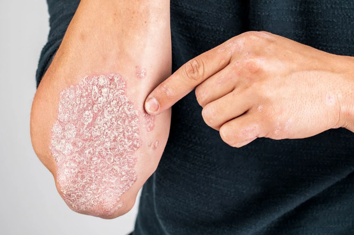 Tự chữa vẩy nến, nhiều người rước họa vào thân - Ảnh 3.