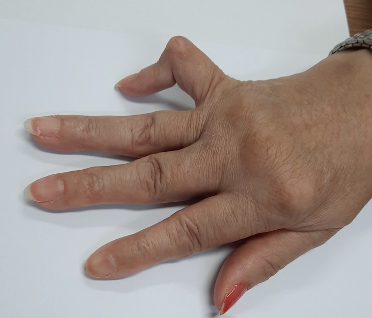 Làm sao giảm các triệu chứng viêm khớp dạng thấp - Ảnh 1. Làm sao giảm các triệu chứng viêm khớp dạng thấp - Ảnh 1.