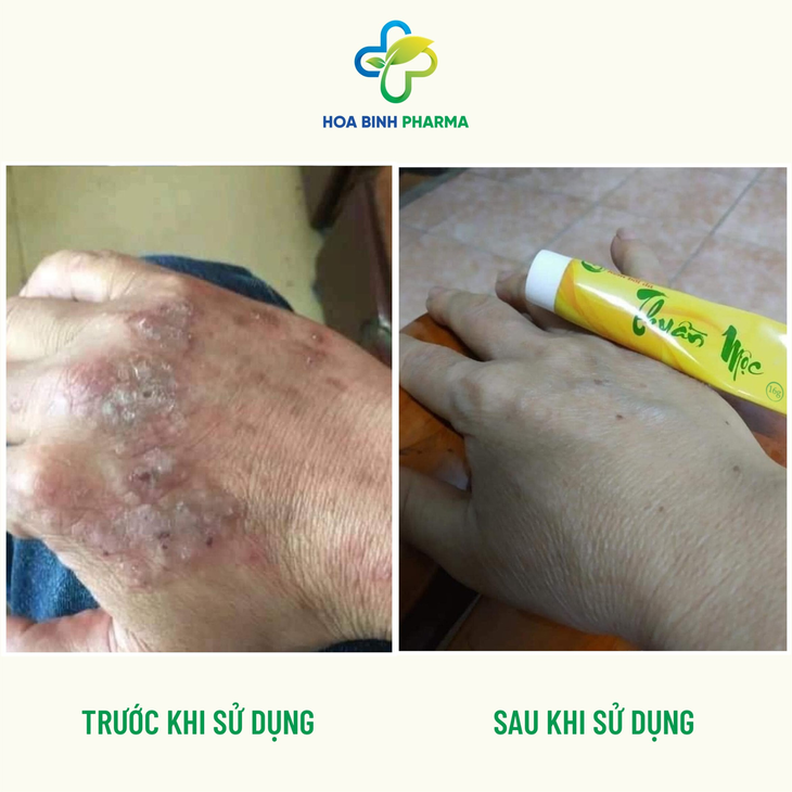 Chọn kem bôi da không chứa corticoid - Ảnh 1.
