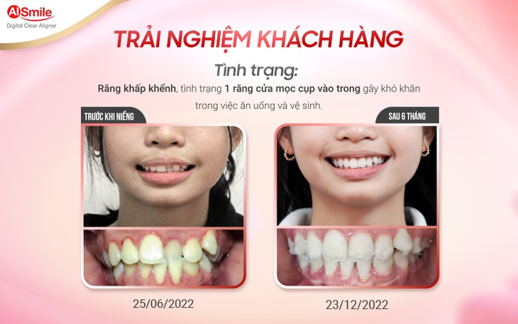Niềng răng trong suốt và niềng răng mắc cài: nên chọn phương pháp nào? - Ảnh 4.