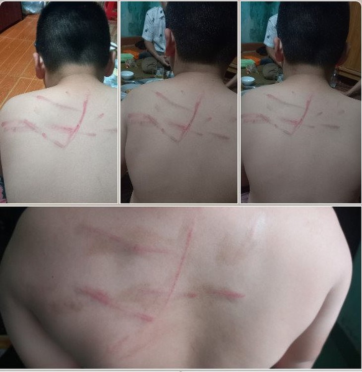 Thông tin mới nhất vụ học sinh lớp 4 bị cô giáo đánh bầm tím lưng do không làm bài tập - Ảnh 1. Thông tin mới nhất vụ học sinh lớp 4 bị cô giáo đánh bầm tím lưng do không làm bài tập - Ảnh 1.