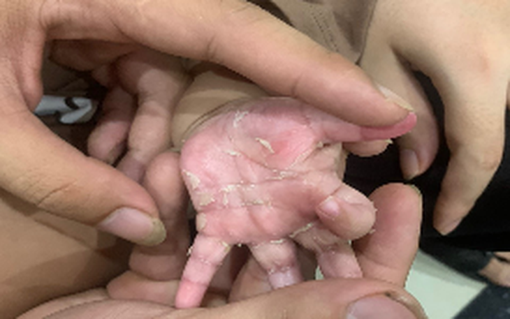 Bé trai 3 tháng tuổi lây giang mai từ mẹ