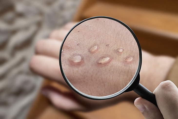 Người bệnh HIV cần biết tự bảo vệ mình khỏi nguy cơ mắc đậu mùa khỉ - Ảnh 2. Người bệnh HIV cần biết tự bảo vệ mình khỏi nguy cơ mắc đậu mùa khỉ - Ảnh 2.