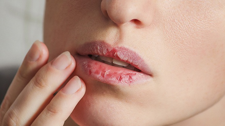 Cách trị môi khô nẻ tại nhà khi trời hanh khô - Ảnh 1.