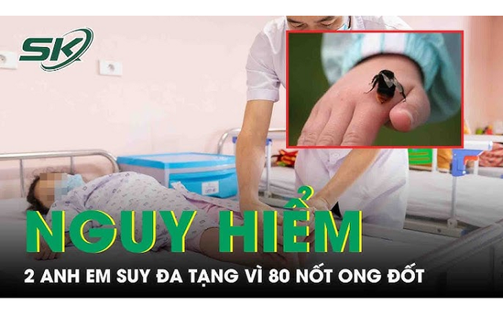 2 trẻ suy đa tạng do ong đốt