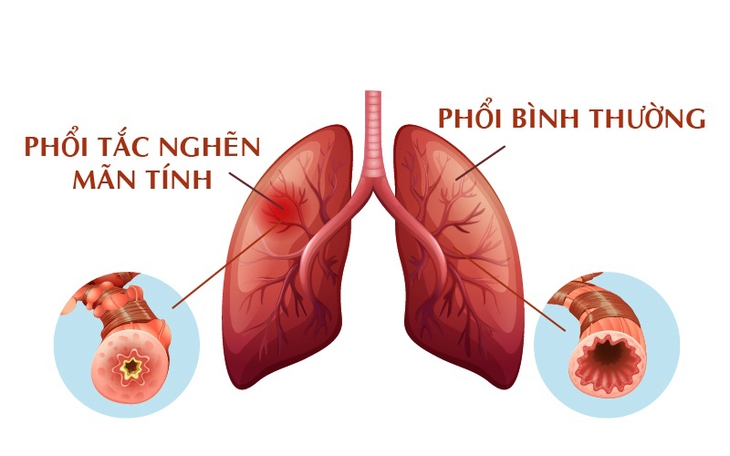Bệnh phổi tắc nghẽn mạn tính: Nguyên nhân gây tử vong xếp hàng thứ 3 - Ảnh 2. Bệnh phổi tắc nghẽn mạn tính: Nguyên nhân gây tử vong xếp hàng thứ 3 - Ảnh 2.