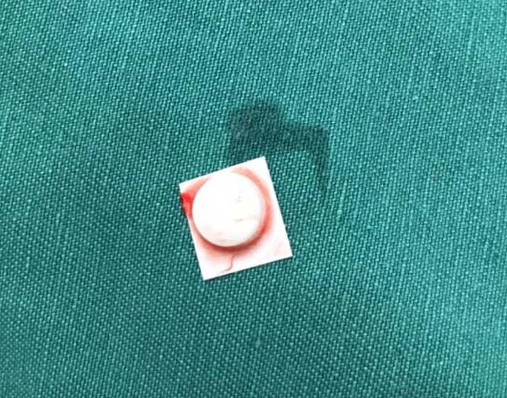 Vỏ thuốc nằm gọn trong khí quản chỉ vì bệnh nhân quên - Ảnh 1.