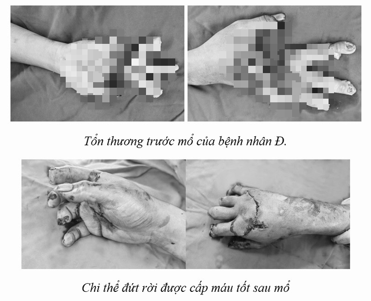4 giờ nối thành công 3 ngón tay bị đứt rời do tai nạn lao động - Ảnh 1. 4 giờ nối thành công 3 ngón tay bị đứt rời do tai nạn lao động - Ảnh 1.