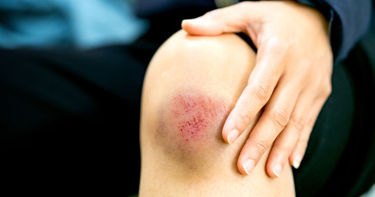 Các vết thương, vết rách trên da dù nhỏ hay lớn đều có thể bị nhiễm trùng nếu không được xử lý đúng cách và kịp thời. Ảnh minh họa Các vết thương, vết rách trên da dù nhỏ hay lớn đều có thể bị nhiễm trùng nếu không được xử lý đúng cách và kịp thời. Ảnh minh họa