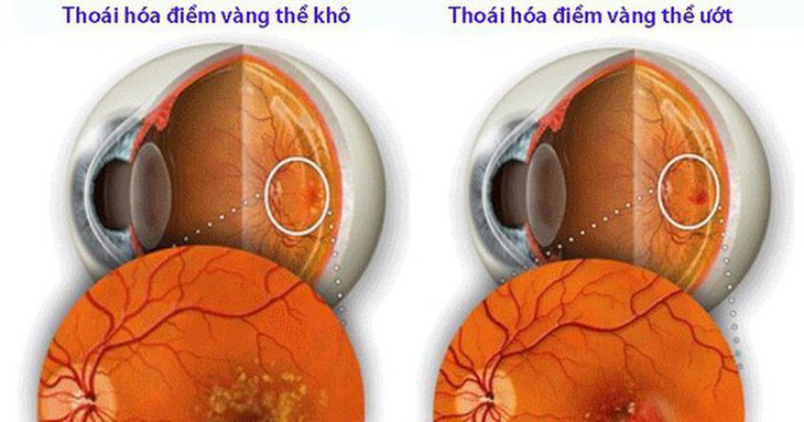 Ngăn thoái hóa điểm vàng ở người cao tuổi với 5 lưu ý sau - Ảnh 2. Ngăn thoái hóa điểm vàng ở người cao tuổi với 5 lưu ý sau - Ảnh 2.