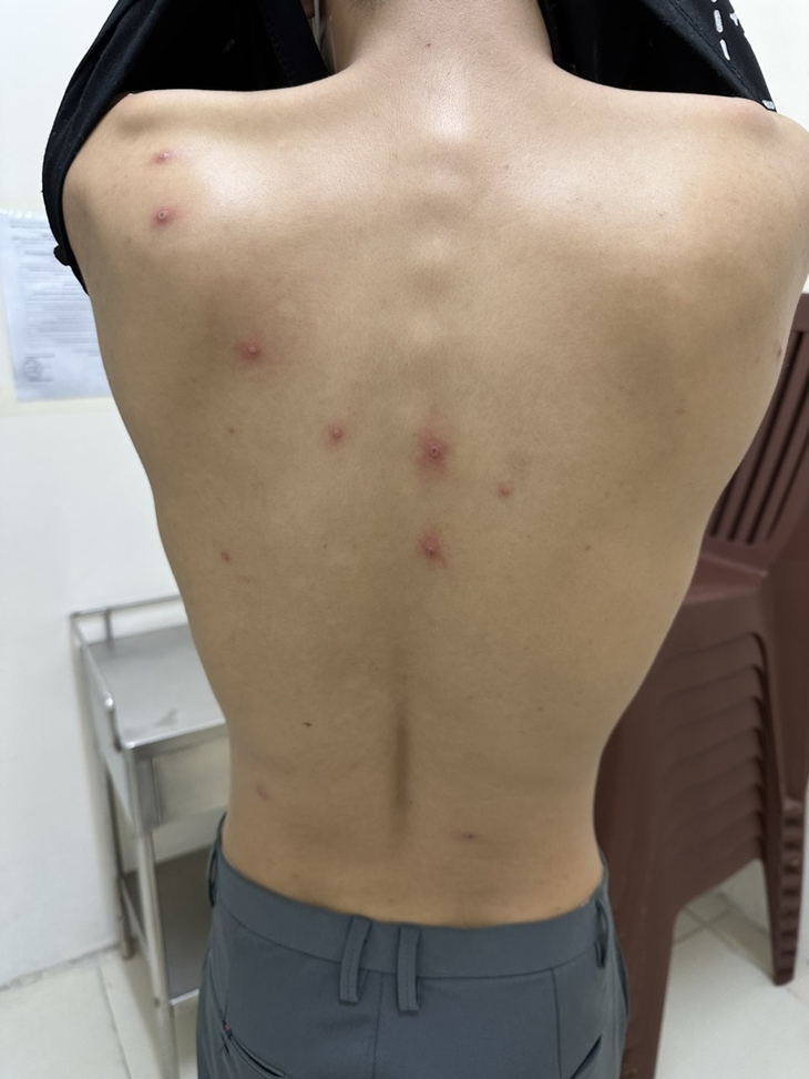 Một ngày phát hiện 4 ca mắc đậu mùa khỉ, TPHCM có lo ngại bùng phát dịch? - Ảnh 1. Một ngày phát hiện 4 ca mắc đậu mùa khỉ, TPHCM có lo ngại bùng phát dịch? - Ảnh 1.