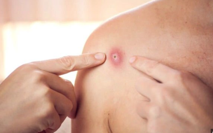 Một ngày phát hiện 4 ca mắc đậu mùa khỉ, TPHCM có nguy cơ bùng phát dịch?