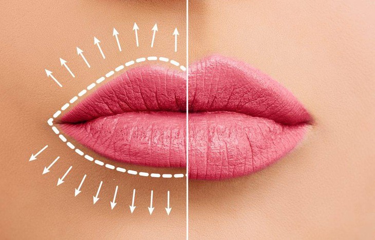 Môi mỏng đi có phải là dấu hiệu của lão hoá? - Ảnh 1. Môi mỏng đi có phải là dấu hiệu của lão hoá? - Ảnh 1.