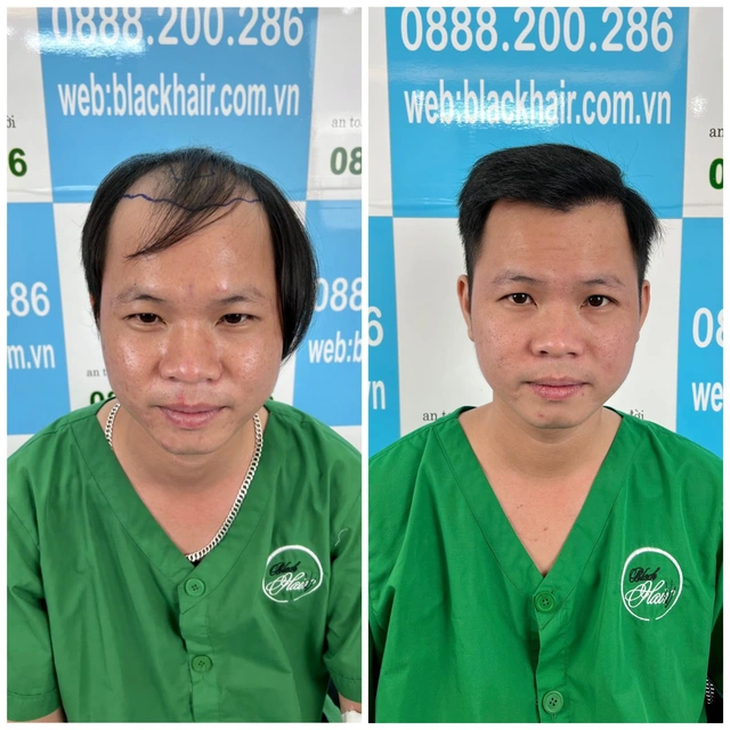 Giải mã phương pháp cấy tóc tiên tiến hiện nay - Ảnh 3.