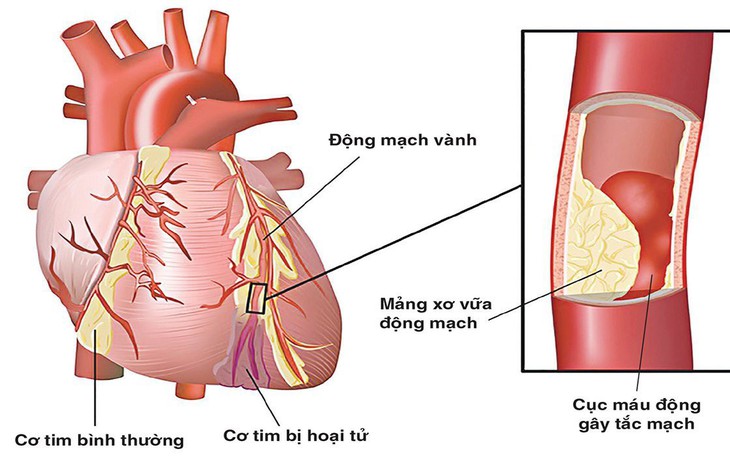 8 dấu hiệu của bệnh tim cần đi khám ngay