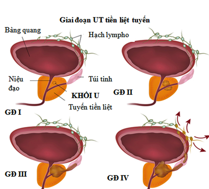 5 điều nam giới cần biết về ung thư tuyến tiền liệt - Ảnh 3. 5 điều nam giới cần biết về ung thư tuyến tiền liệt - Ảnh 3.