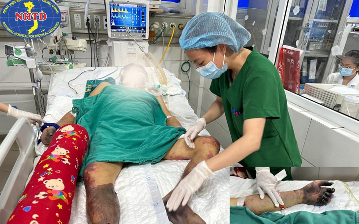 Ăn một miếng dồi lợn, người đàn ông phải cắt bỏ 2 bàn chân và ngón tay