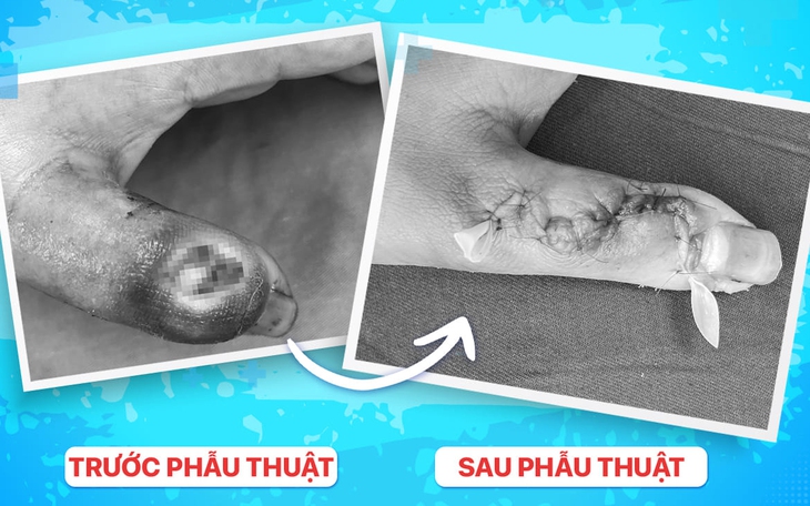 Hoại tử ngón tay do tự ý đắp thuốc lá của thầy lang