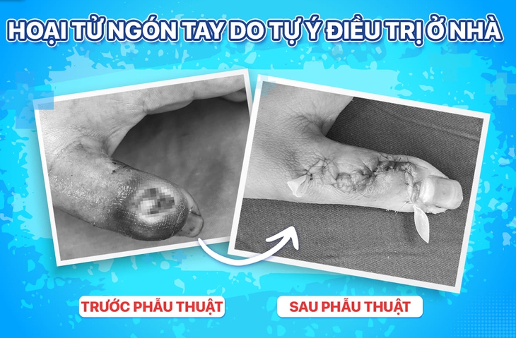 Hoại tử ngón tay do tự ý đắp thuốc lá - Ảnh 1.