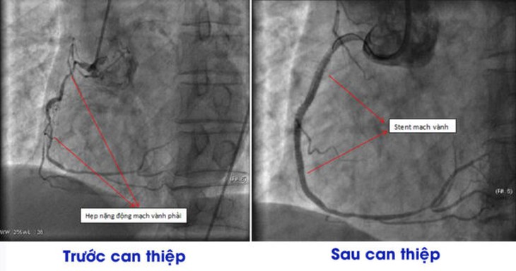 Hội chẩn liên khoa, cứu sống người bệnh nhồi máu cơ tim biến chứng sốc tim - Ảnh 2. Hội chẩn liên khoa, cứu sống người bệnh nhồi máu cơ tim biến chứng sốc tim - Ảnh 2.