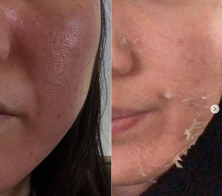 Da sạm hơn sau khi dùng retinol, cách nào khắc phục? - Ảnh 1. Da sạm hơn sau khi dùng retinol, cách nào khắc phục? - Ảnh 1.
