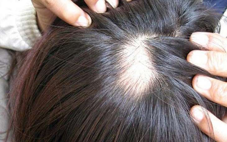 Chứng hói đầu ở nam giới thường xuất phát do nguyên nhân di truyền nên rất khó để phục hồi.