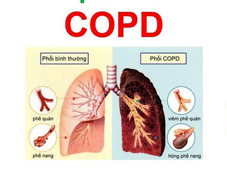 Người bệnh phổi tắc nghẽn mạn tính có nên đi bộ không?- Ảnh 1. Người bệnh phổi tắc nghẽn mạn tính có nên đi bộ không?- Ảnh 1.