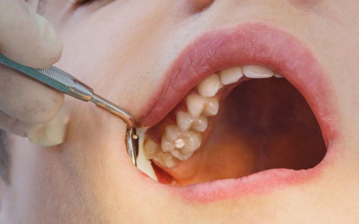 3 thứ cần biết, 6 điều cần làm sau khi nhổ răng khôn