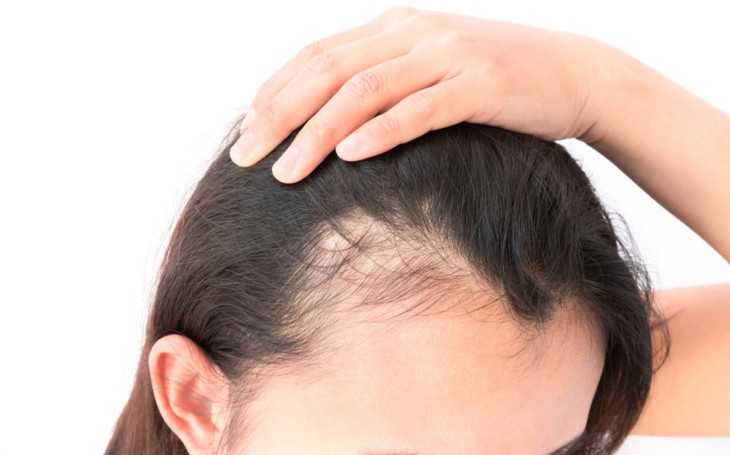 Chế độ ăn uống ảnh hưởng đến rụng tóc như thế nào?- Ảnh 1.