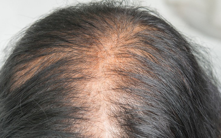 Rụng tóc sau sinh do đâu, bao lâu thì hết