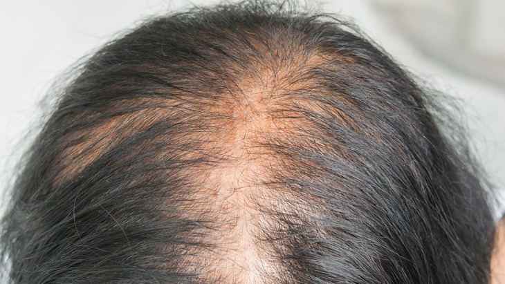 Rụng tóc sau sinh do đâu, bao lâu thì hết- Ảnh 2. Rụng tóc sau sinh do đâu, bao lâu thì hết- Ảnh 2.