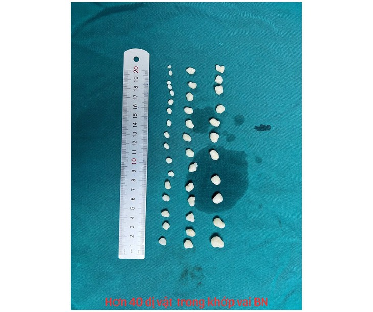 Tá hỏa lấy ra 40 khối u sụn trong khớp vai nữ thanh niên- Ảnh 2. Tá hỏa lấy ra 40 khối u sụn trong khớp vai nữ thanh niên- Ảnh 2.