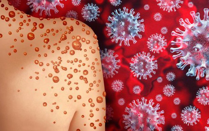 Người nhiễm HIV bị suy giảm miễn dịch dễ đồng nhiễm đậu mùa khỉ
