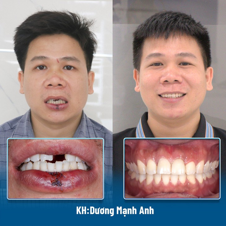 Cảnh báo tình trạng giắt răng sau cấy ghép implant- Ảnh 4.